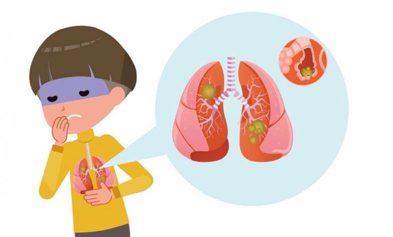 Causes of pneumonia in children