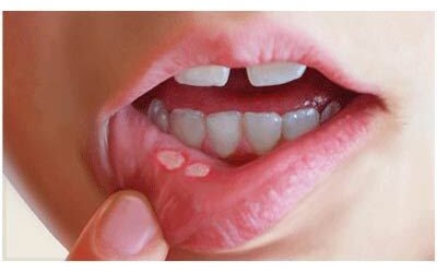 آفت دهان کودک