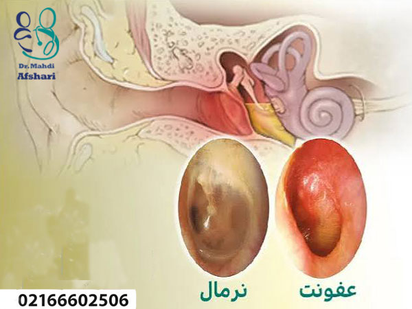 عفونت گوش در کودکان