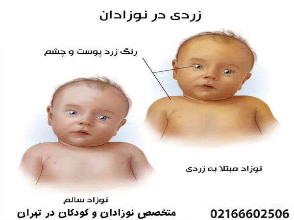 علائم خطر زردی نوزاد
